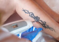 Tattoo Removal: Banish Your Youth Mistake