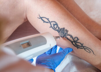 Tattoo Removal: Banish Your Youth Mistake