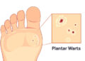 Plantar Warts