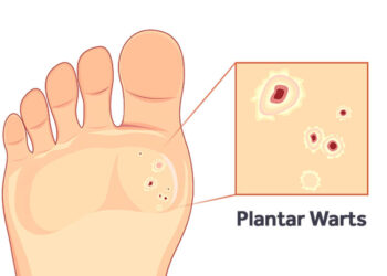 Plantar Warts