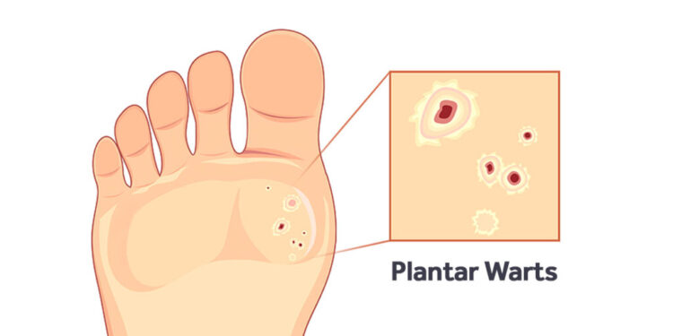 Plantar Warts