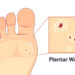 Plantar Warts