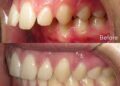 treat Overbite