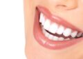 Preparing for Teeth Whitening: A Guide for Glebe Residents