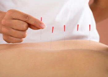 Dry Needling
