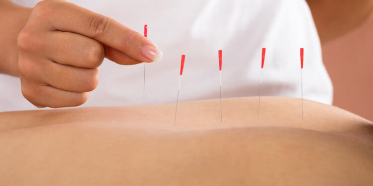 Dry Needling