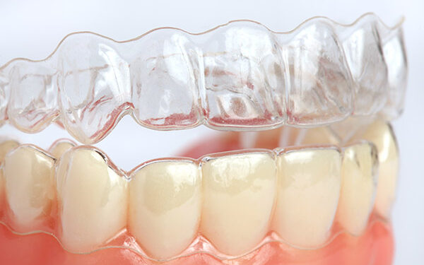 Invisalign or Braces in Los Angeles