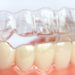 Invisalign or Braces in Los Angeles