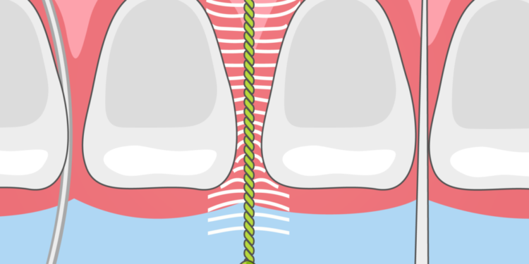 Interdental Cleaners