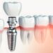 How Dental Implants Can Transform Your Smile and Boost Confidence