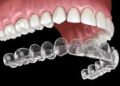 Invisalign: The Clear Choice for a Straighter Smile