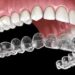 Invisalign: The Clear Choice for a Straighter Smile