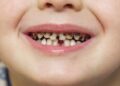 Common Pediatric Dental Issues and How to Prevent Them