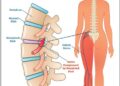 Effective Non-Surgical Solutions for Sciatica Treatment