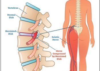 Effective Non-Surgical Solutions for Sciatica Treatment