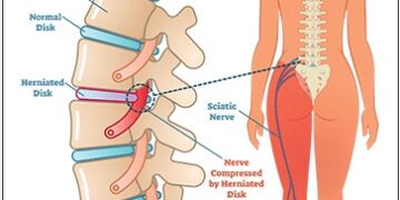 Effective Non-Surgical Solutions for Sciatica Treatment