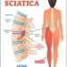 Effective Non-Surgical Solutions for Sciatica Treatment